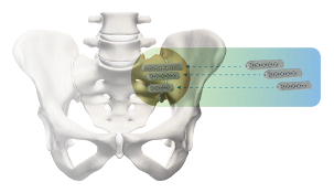 The iFuse Implant System is designed to produce stabilization and fusion for certain SI joint disorders.