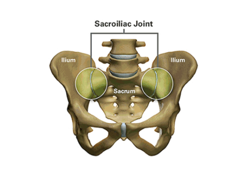 The SI joint is the link between the ilium in the pelvis to the sacrum, which is the lowest part of the spine above the tailbone.