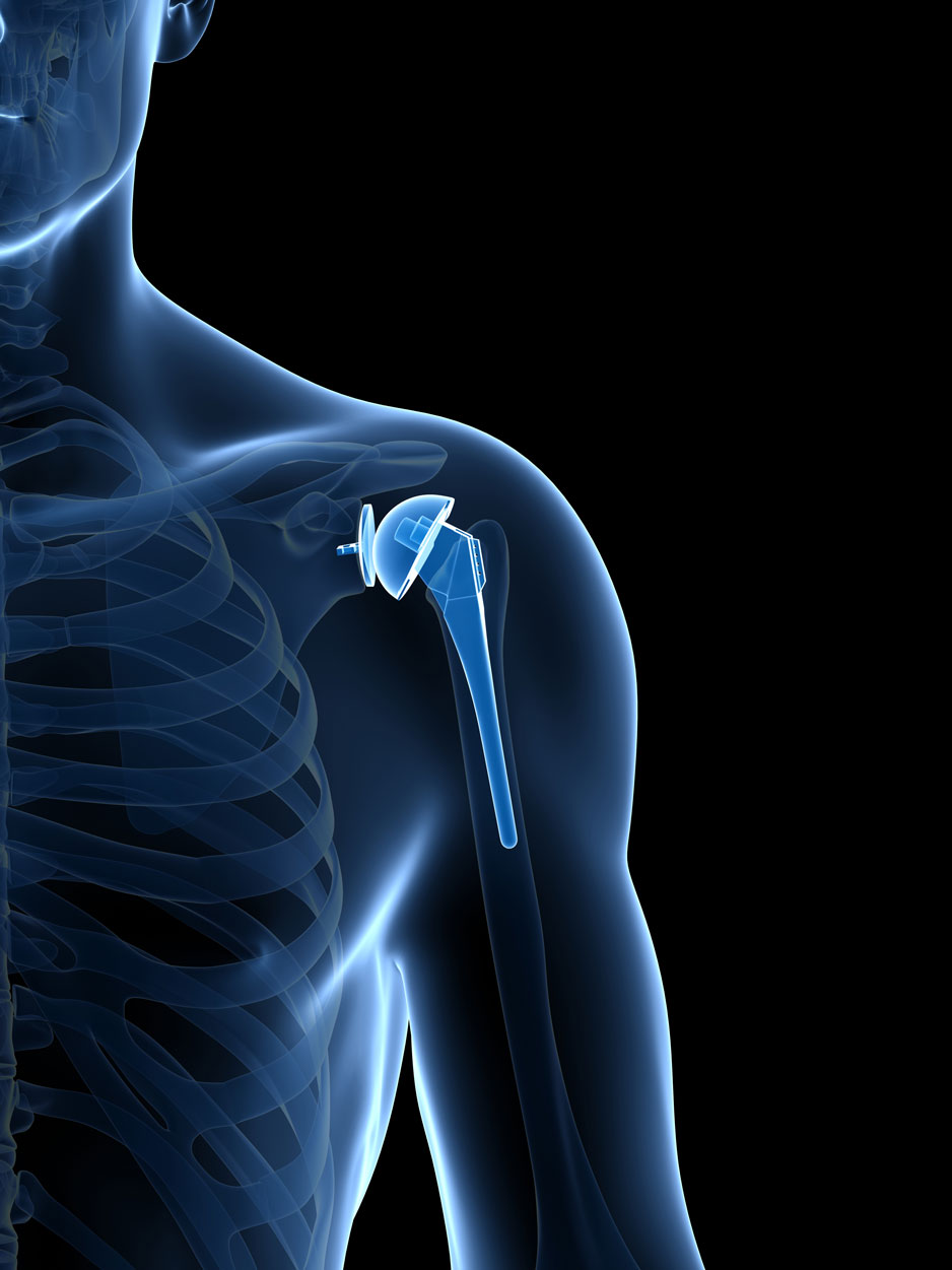 Total Shoulder Replacement Orthopaedic Surgery