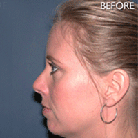 Chin Augmentation - Before