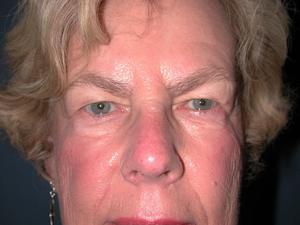 Eyelid Surgery - Before