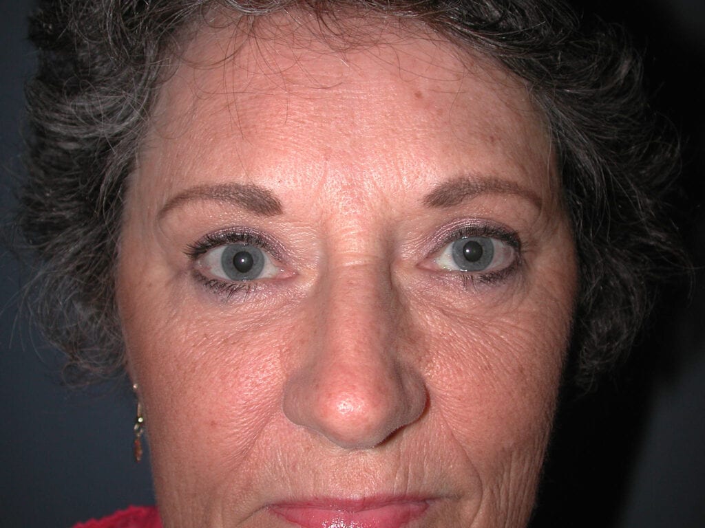Eyelid Surgery - After
