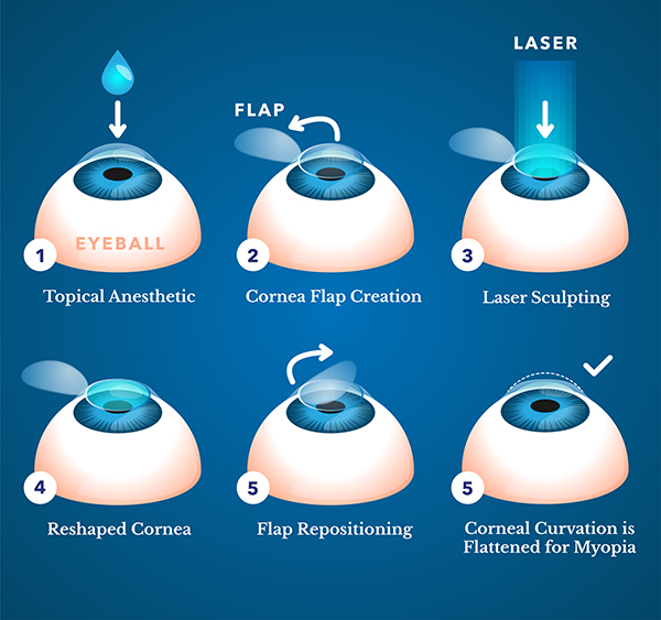 LASIK Eye Surgery Pinehurst Surgical Clinic